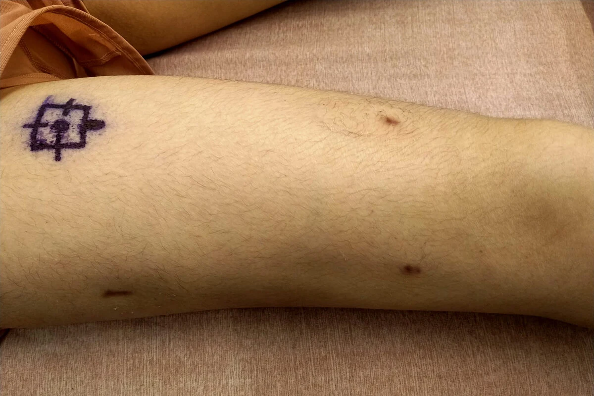 脚延長手術のビフォーアフター写真|患者様の実例